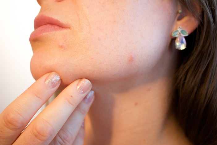 Acne e imperfezioni cutanee: cosa fare e a chi rivolgersi