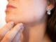 Acne e imperfezioni cutanee: cosa fare e a chi rivolgersi