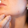 Acne e imperfezioni cutanee: cosa fare e a chi rivolgersi