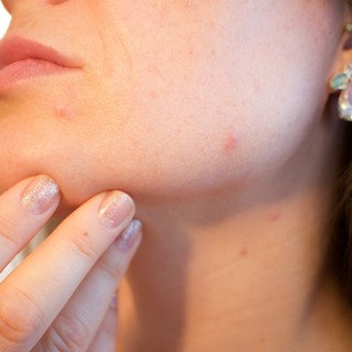 Acne e imperfezioni cutanee: cosa fare e a chi rivolgersi