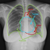 Radiografia della donna operata di tumore alle Molinette