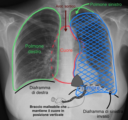 radiografia ai polmoni