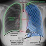 radiografia ai polmoni