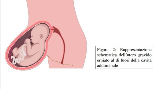 Il feto sta in un'ernia fuori dall'addome: i medici del Sant'Anna fanno nascere una bimba con un intervento eccezionale